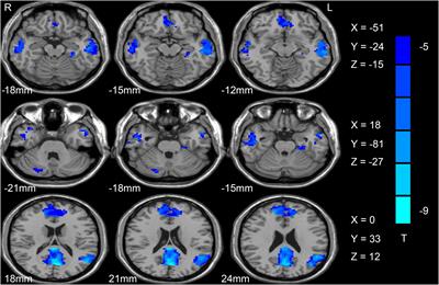 Decreased resting-state neural signal in the left angular gyrus as a potential neuroimaging biomarker of schizophrenia: An amplitude of low-frequency fluctuation and support vector machine analysis